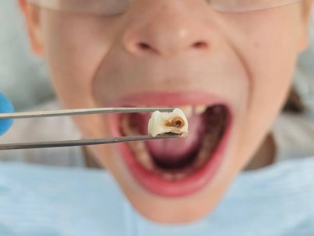 Best Broken or Chipped Tooth Repair in Lake Caroline, VA
